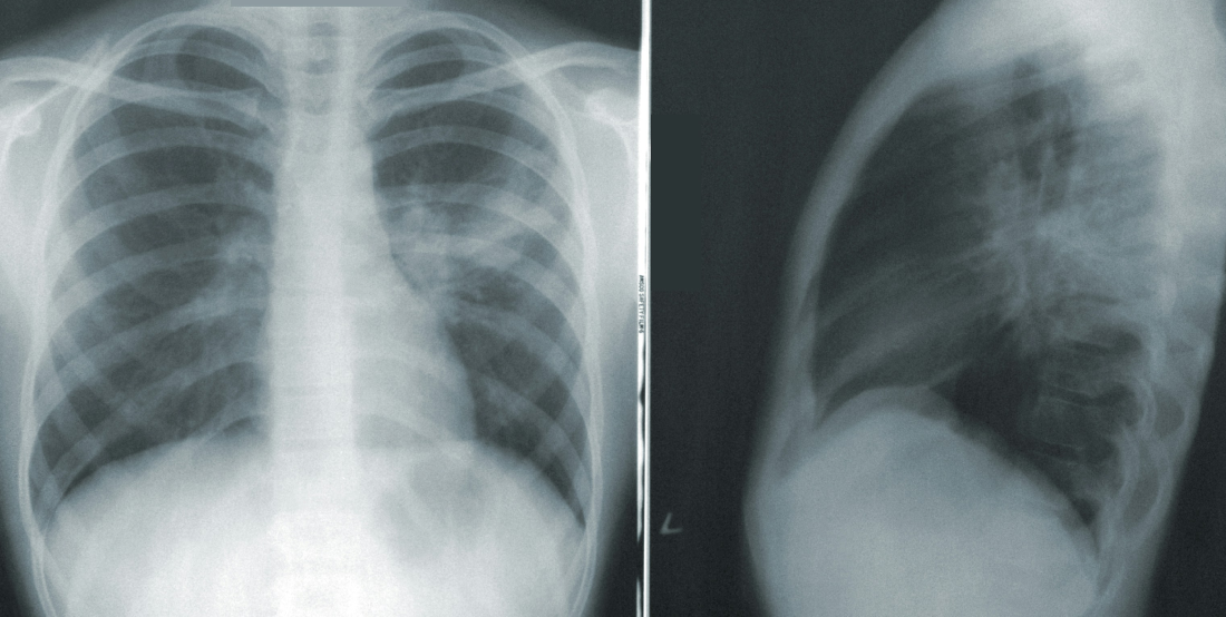 fatality lung xray