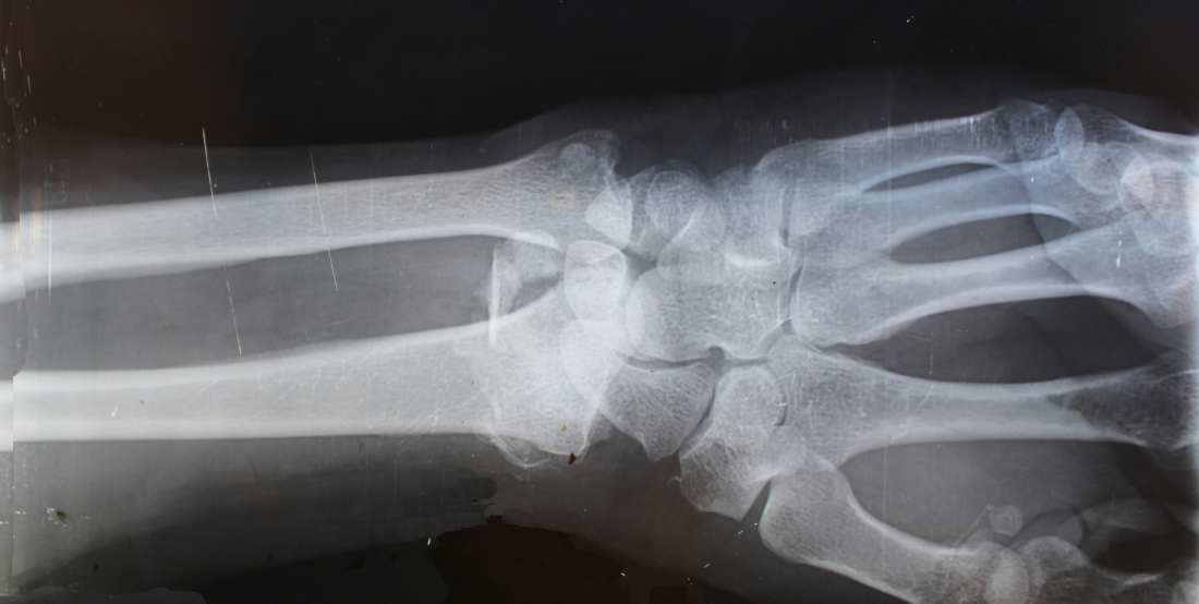 broken arm image