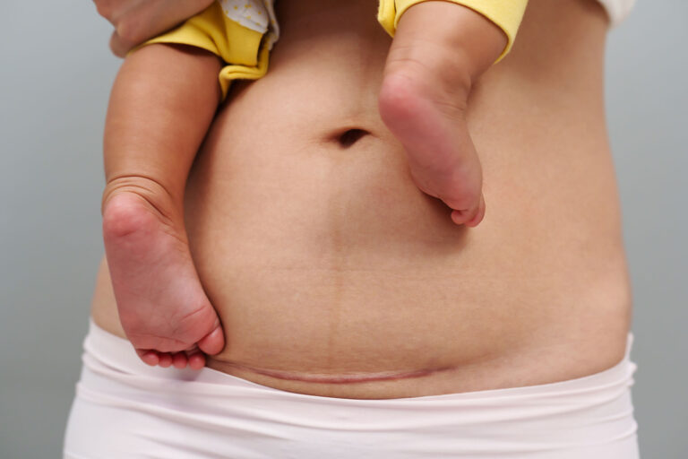 A mother holding her baby against her, showing a healed caesarean section scar